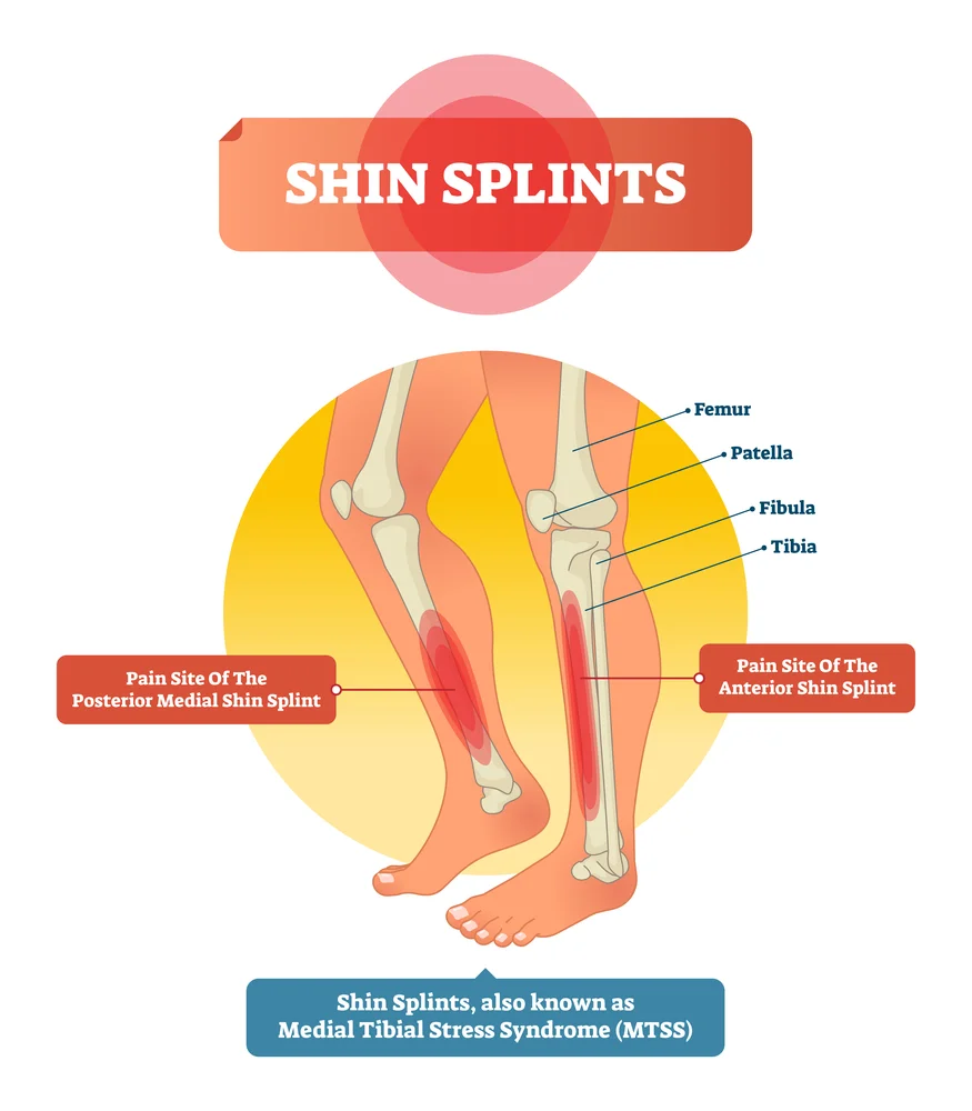Medial Tibial Stress Syndrome Part 1 What Are Shin Splints and Why Runners Revive Sport Spine